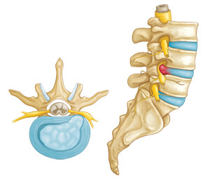Herniated disc: axial and lateral